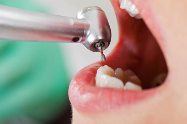 Best Lost Filling or Crown Replacement in White Island Shores, MA